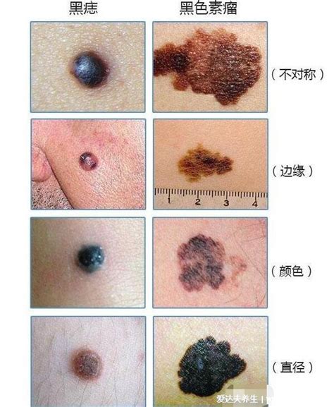 痦子|痣和瘊子有什么区别图片